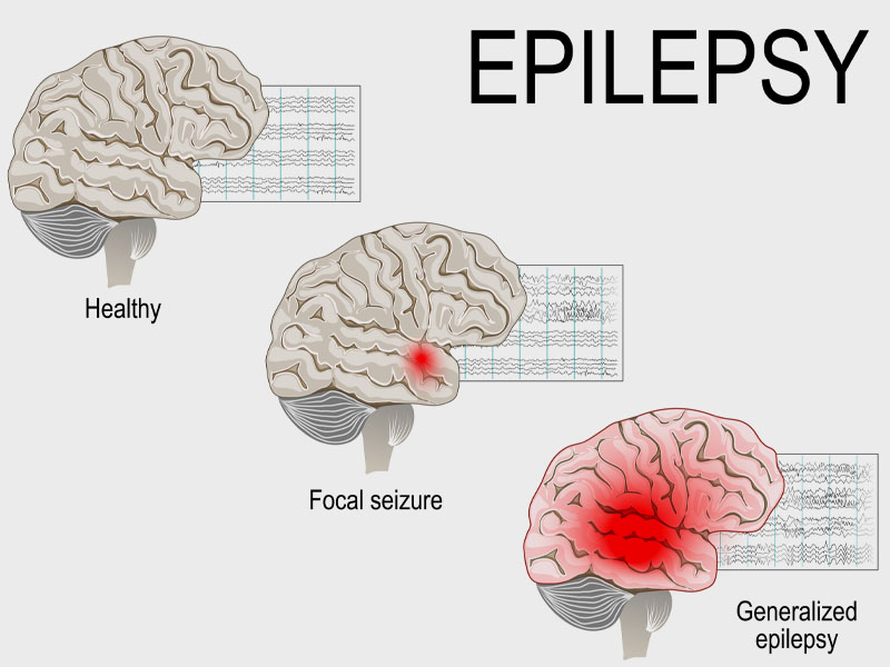 Can Epilepsy Be Cured