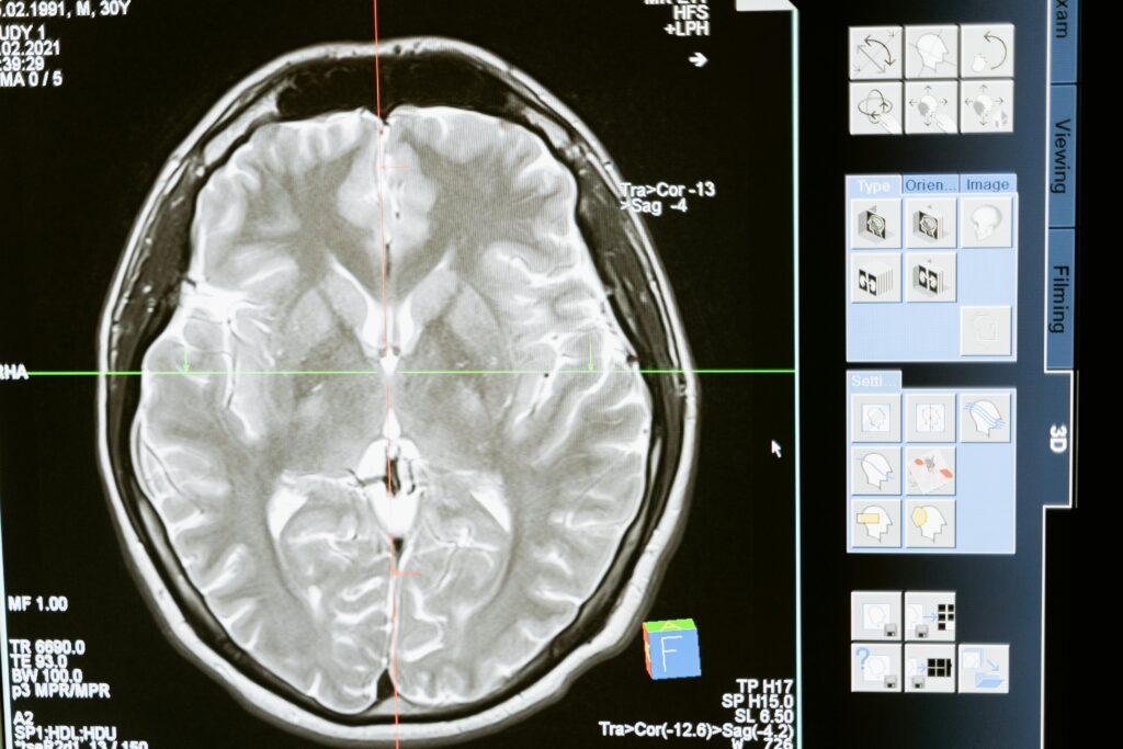 How to Manage Epilepsy in Daily Life – Expert Neurologist Tips