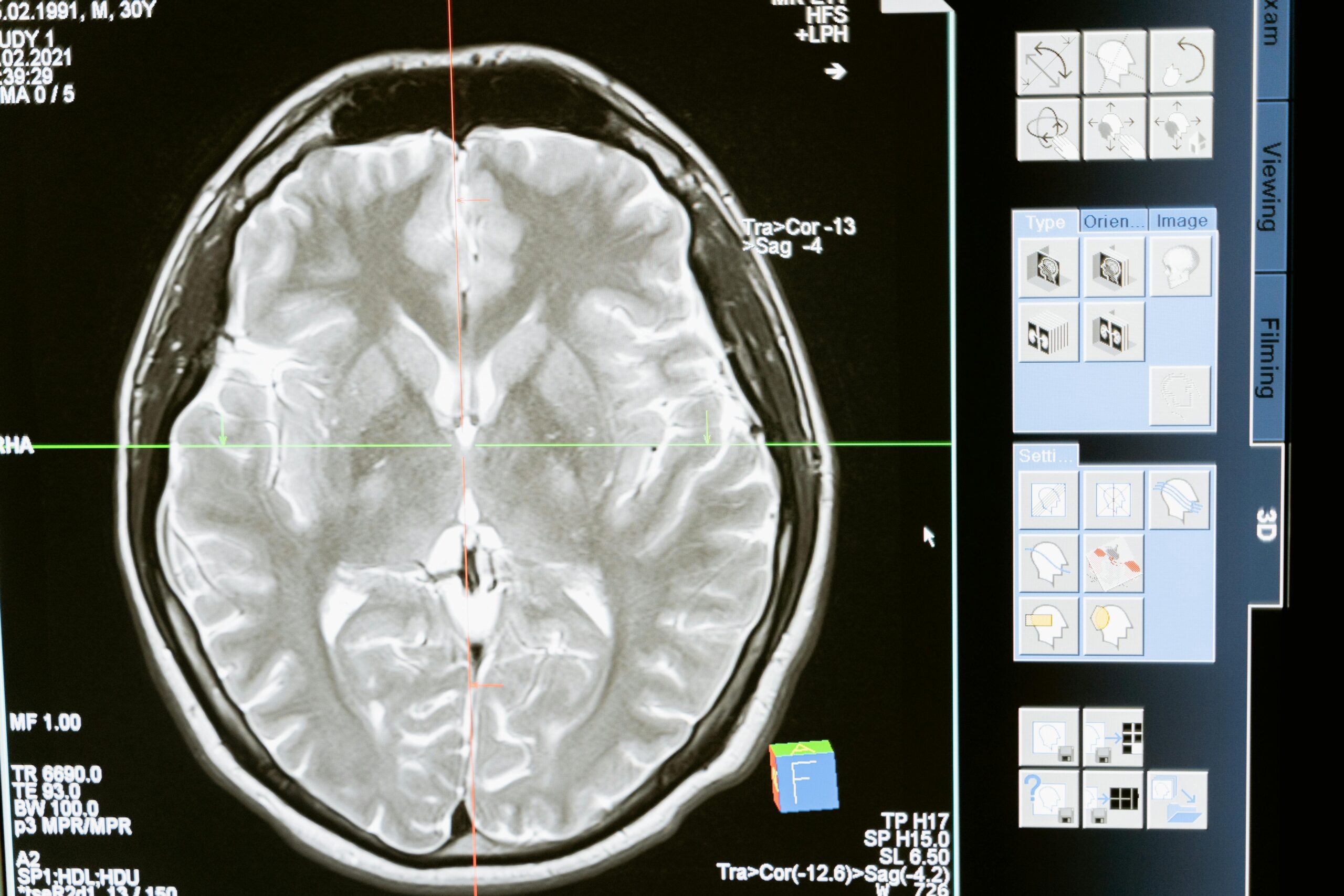How to Manage Epilepsy in Daily Life – Expert Neurologist Tips